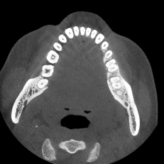 Aksial CBCT